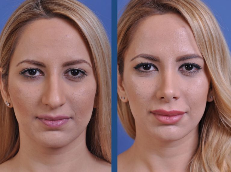 before and after vampire facelift and injectables front view case 3243