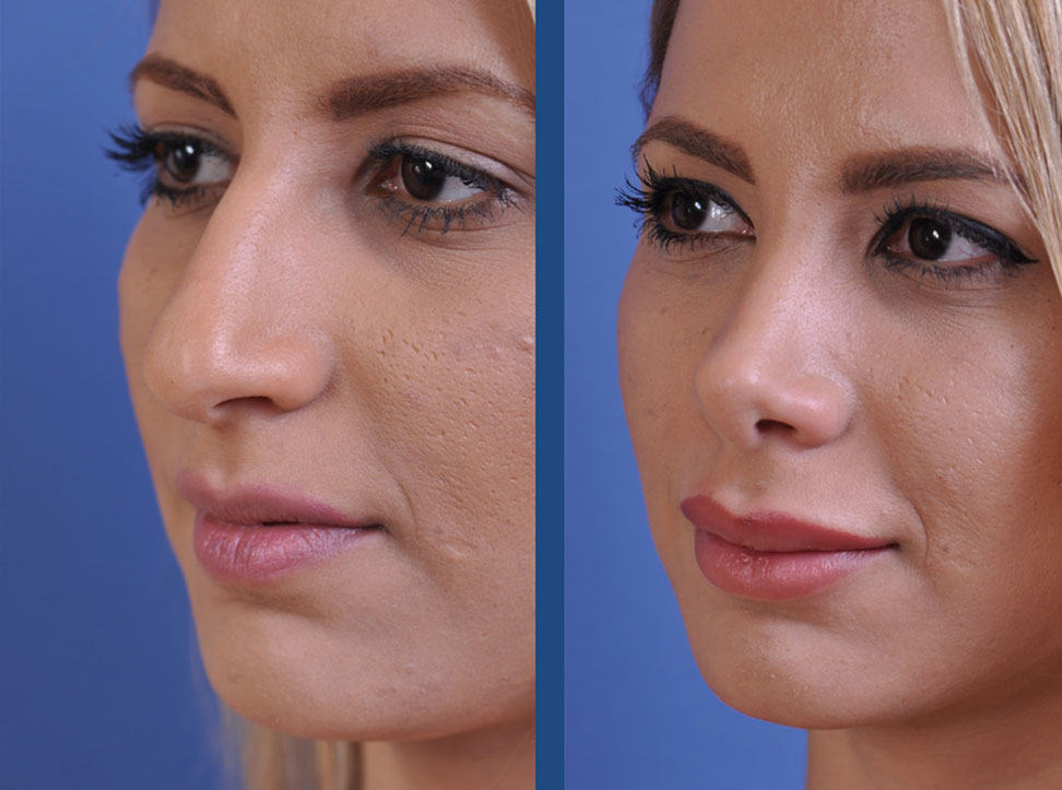before and after vampire facelift and injectables left angle view case 3243