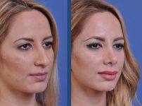 before and after vampire facelift and injectables right angle view case 3243