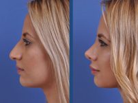 before and after vampire facelift and injectables left side view case 3243