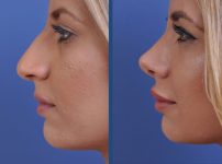 before and after vampire facelift and injectables left side view case 3243