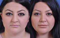 before and after vampire facelift and injectables female patient front view case 3253