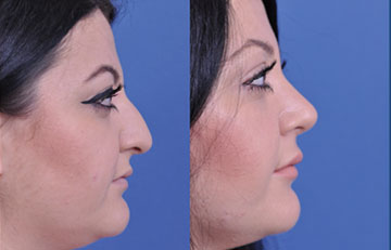before and after vampire facelift and injectables female patient right side view case 3253