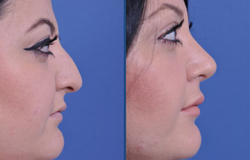 before and after vampire facelift and injectables female patient right side view case 3253