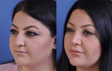 before and after vampire facelift and injectables female patient left angled view case 3253