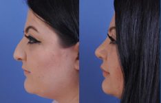 before and after vampire facelift and injectables female patient left side view case 3253