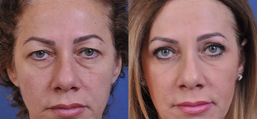 before and after blepharoplasty front view female patient case 4861