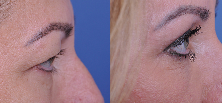 before and after blepharoplasty right side view female patient case 4861