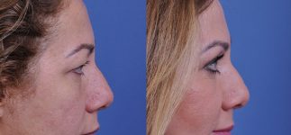 before and after blepharoplasty right side view female patient case 4861