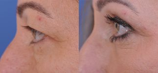 before and after blepharoplasty left side view female patient case 4861