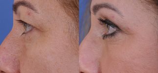 before and after blepharoplasty left side view female patient case 4861