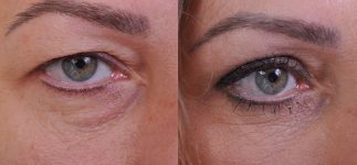 before and after blepharoplasty front right eye view female patient case 4861