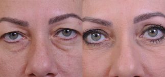 before and after blepharoplasty front view female patient case 4861