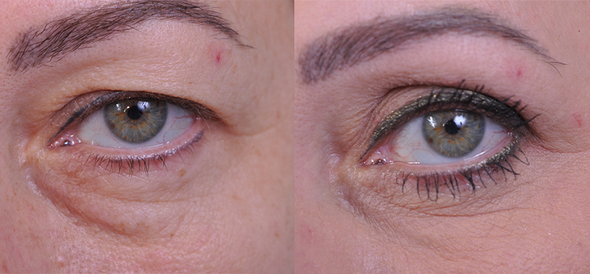 before and after blepharoplasty front left eye view female patient case 4861