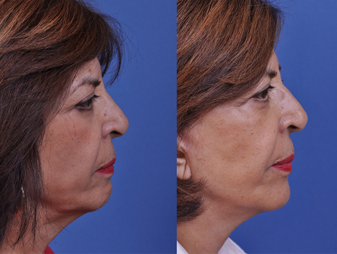before and after chin augmentation right side view female patient case 5009