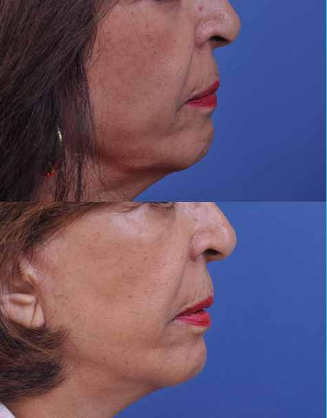 before and after facelift | mid facelift right side closeup view female patient case 5022