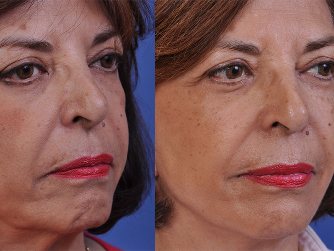 before and after facelift | mid facelift right angle view female patient case 5022