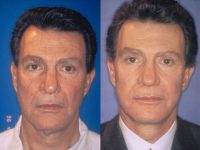 before and after facelift | mid facelift front view male patient case 5027