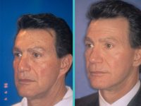 before and after facelift | mid facelift left angle view male patient case 5027