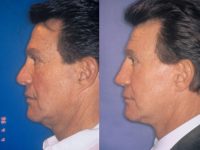 before and after facelift | mid facelift left side view male patient case 5027