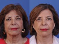 before and after neck lift front view female patient case 5019