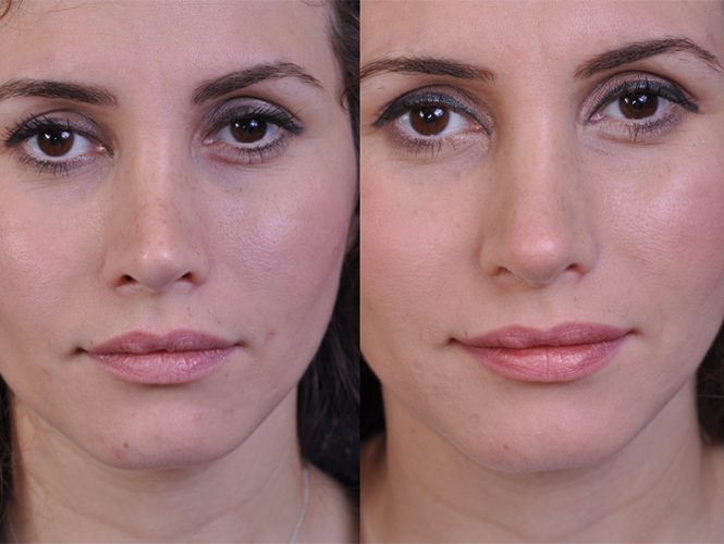 before and after revision rhinoplasty front closeup view female patient case 4943