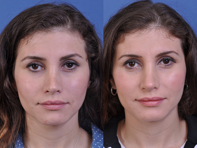 before and after revision rhinoplasty front view female patient case 4943