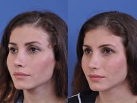 before and after revision rhinoplasty left angle view female patient case 4943