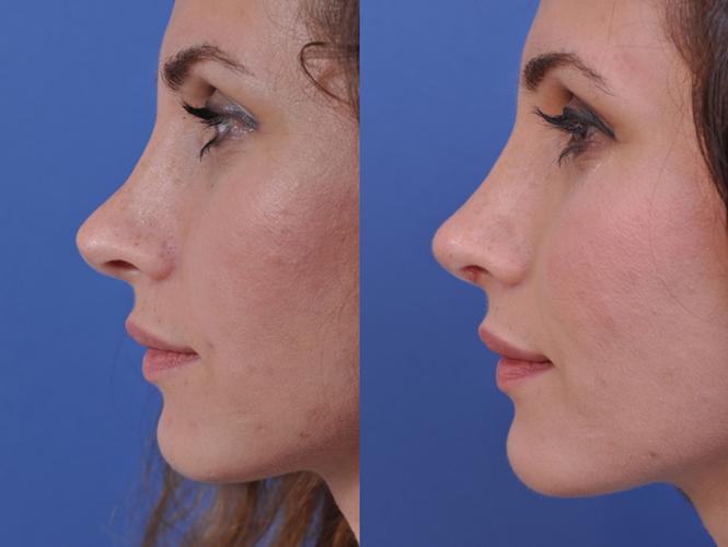 before and after revision rhinoplasty left side view female patient case 4943