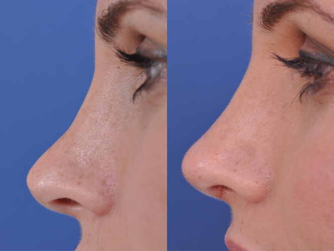 before and after revision rhinoplasty left close up side view female patient case 4943