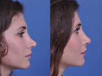 before and after revision rhinoplasty right side view female patient case 4943