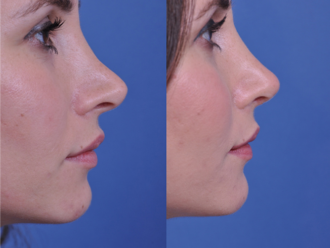 before and after revision rhinoplasty right side closeup view female patient case 4943