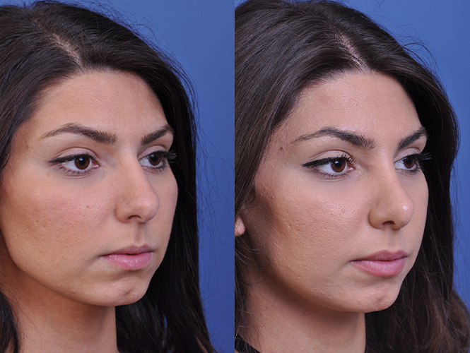 before and after rhinoplasty right angle view female patient case 4813