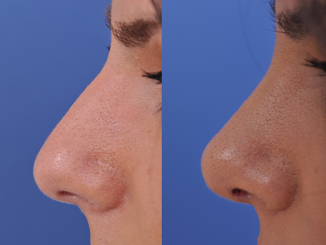 before and after rhinoplasty left side closeup nose view female patient case 4813