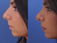before and after rhinoplasty left side angle view female patient case 4813