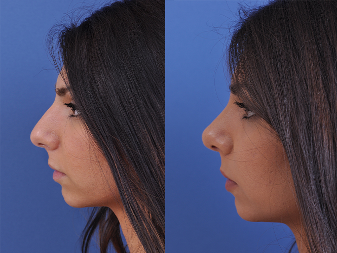 before and after rhinoplasty left side view female patient case 4813