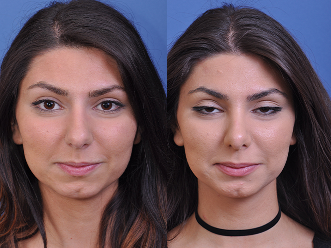 before and after rhinoplasty front view female patient case 4813