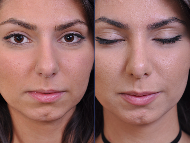 before and after rhinoplasty front closeup view female patient case 4813