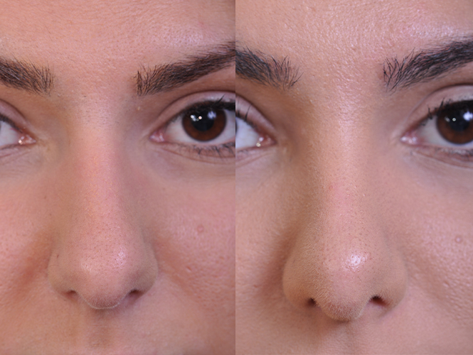 before and after rhinoplasty front closeup nose view female patient case 4813
