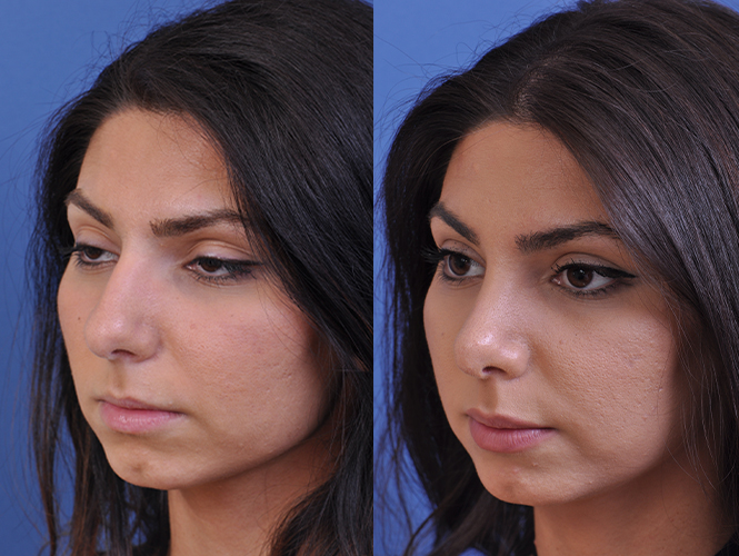 before and after rhinoplasty left angle view female patient case 4813