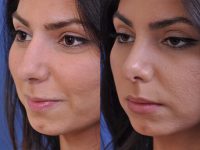 before and after rhinoplasty left angle closeup view female patient case 4813