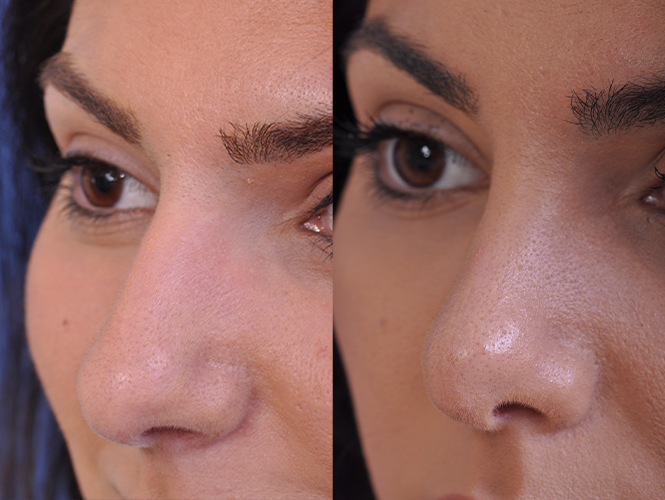 before and after rhinoplasty left angle closeup nose view female patient case 4813