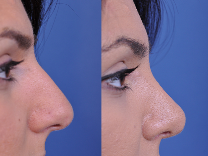 before and after rhinoplasty right side closeup nose view female patient case 4813