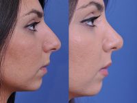 before and after rhinoplasty right side closeup view female patient case 4813