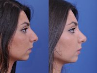 before and after rhinoplasty right side view female patient case 4813