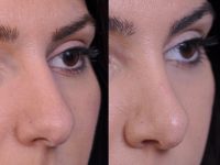 before and after rhinoplasty right angle closeup nose view female patient case 4813