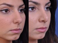before and after rhinoplasty right angle closeup view female patient case 4813