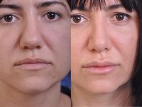 before and after rhinoplasty female patient front closeup view case 4829