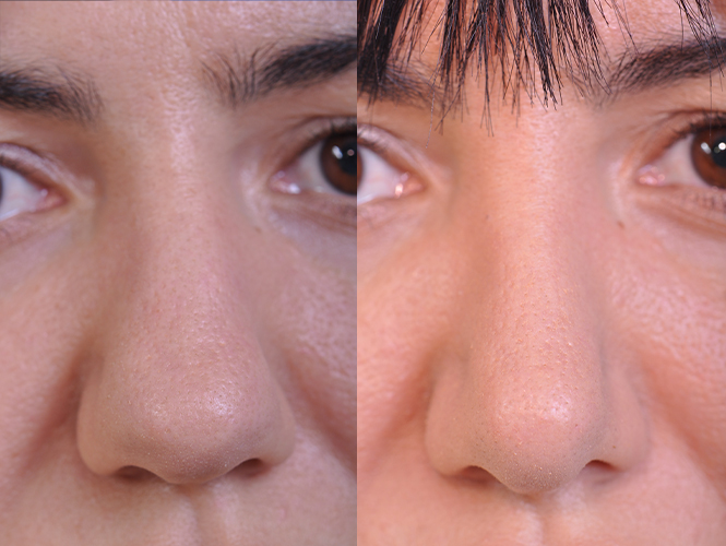 before and after rhinoplasty female patient front nose view case 4829