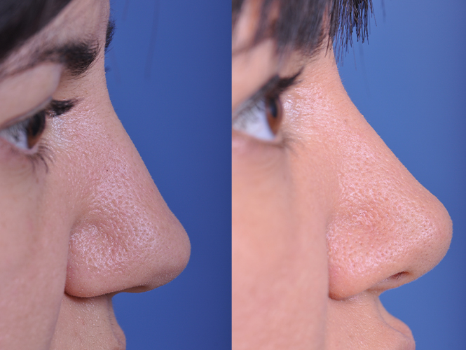 before and after rhinoplasty right side closeup nose view female patient case 4829